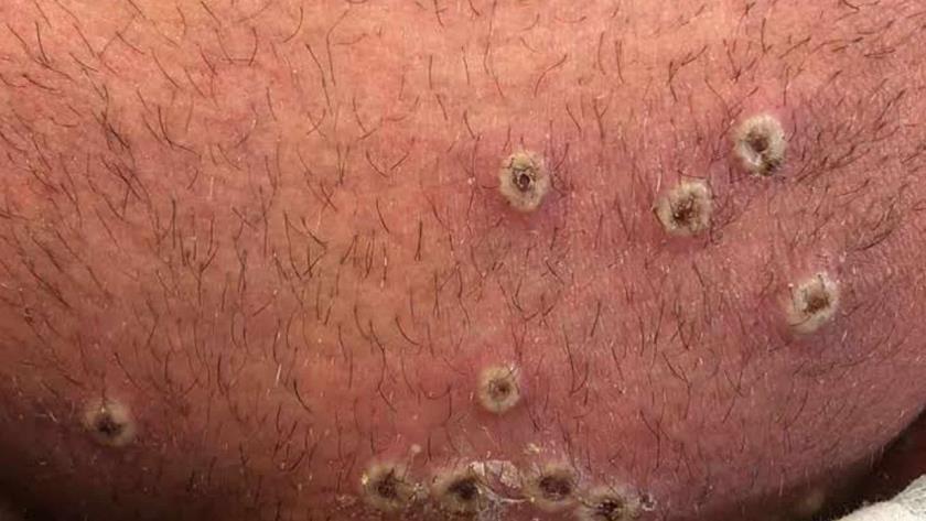 ¡Alerta! Se confirma el primer caso de viruela símica en Jalisco