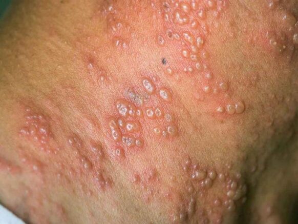 Viruela-simica-1-582x437