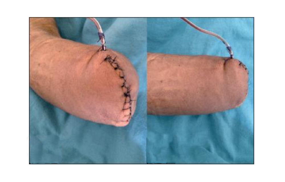 Pirotecnia deja amputaciones y secuelas permanentes en Hermosillo