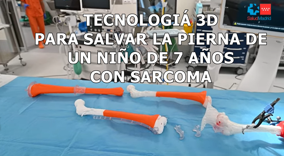 Tecnología 3D y un trasplante óseo salvan la pierna de un niño con cáncer