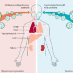 Hantavirus: una enfermedad poco común, pero que debemos conocer y prevenir gr1